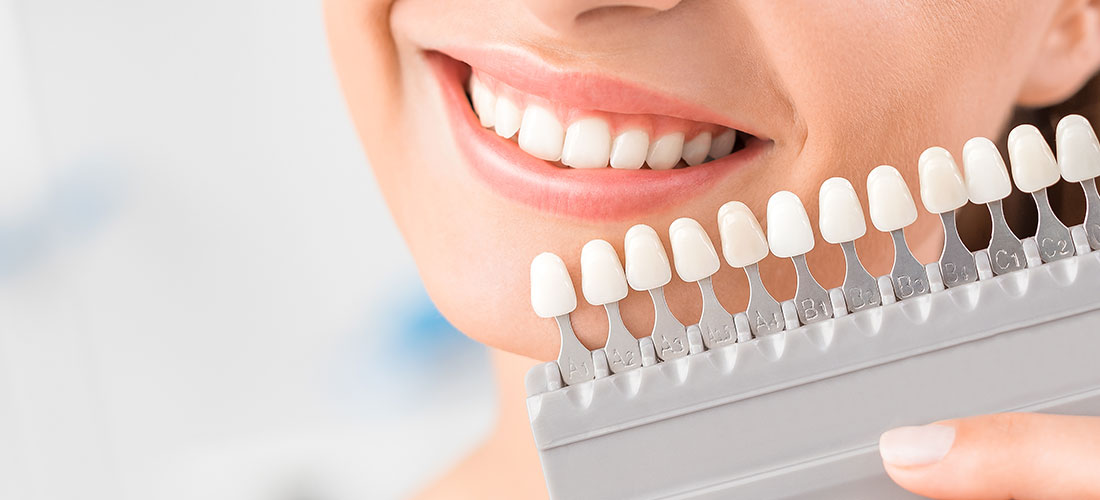 Mujer en el dentista junto a carillas dentales