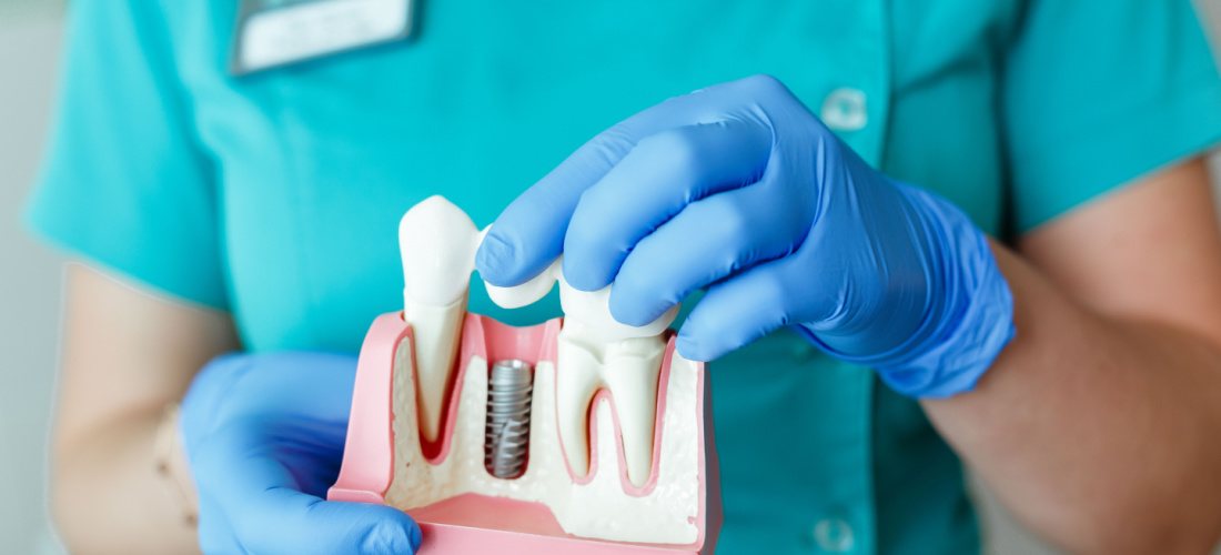 dentista colocando implantes dentales